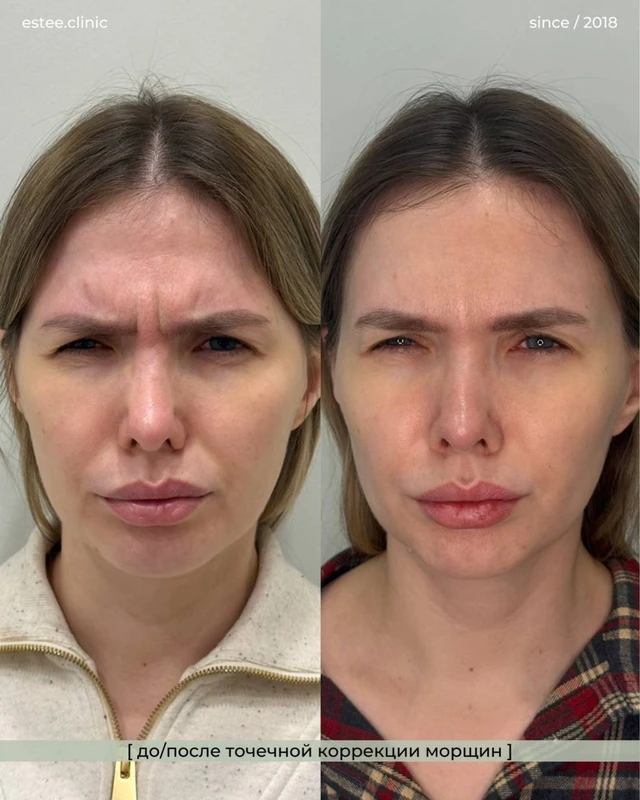 Ботулинотерапия